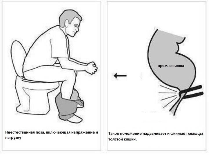 Почему нельзя и что будет если долго сидеть в туалете — проктологи предупреждают